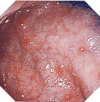 �N���[���a�摜