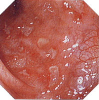 �N���[���a�摜