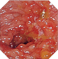 �N���[���a�摜