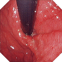 �N���[���a�摜