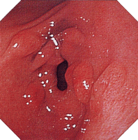 �N���[���a�摜